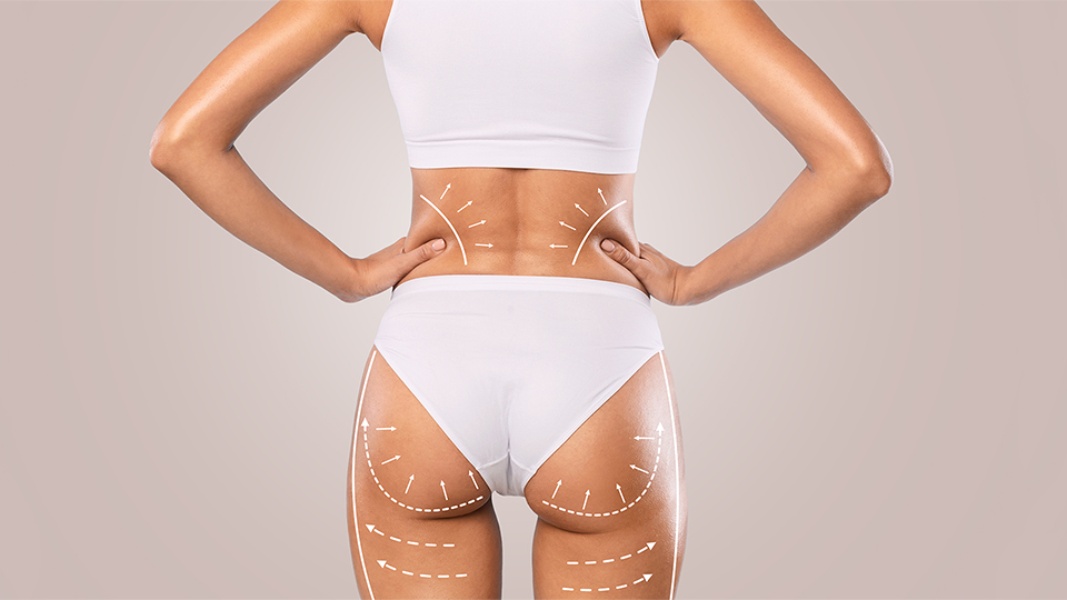 Μεσοθεραπεία σώματος