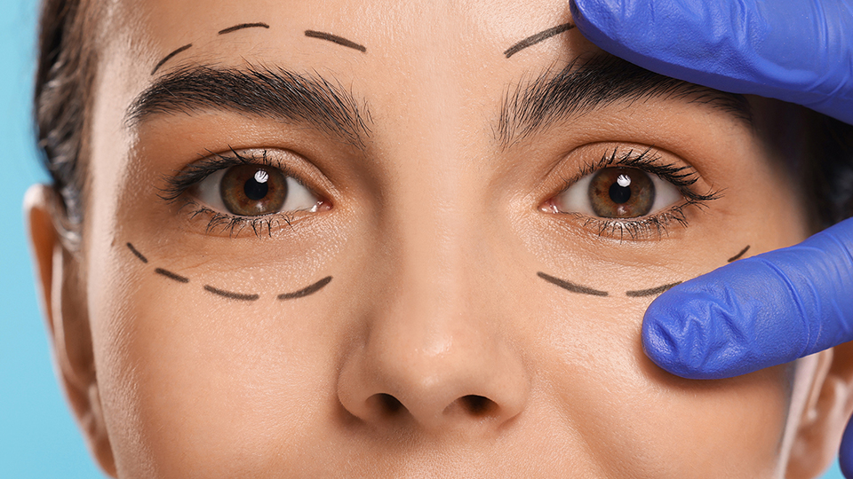 Βλεφαρόπτωση