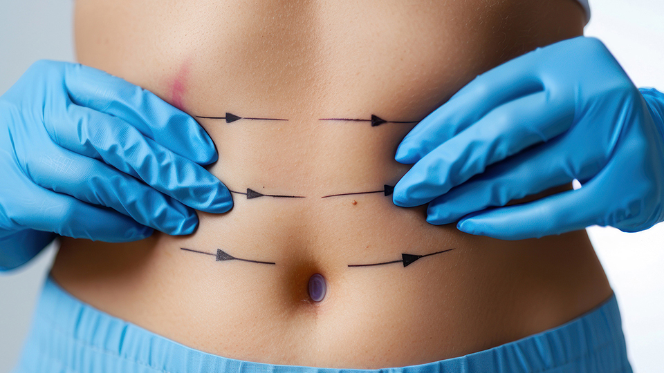 Λιποαναρρόφηση